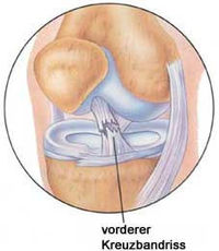 Kreuzbandriss - die Mutter aller Arschlöcher!!!