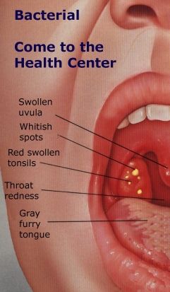 tonsillitis- eitige angina - 