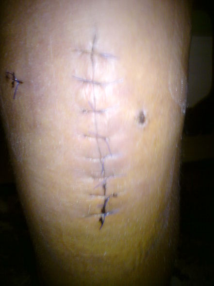 Mein KNIE..!! - 