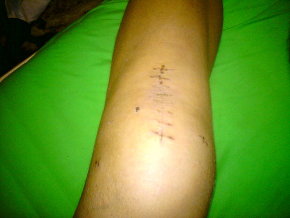 Mein KNIE..!! - 